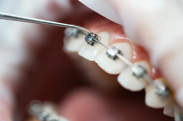  Nahaufnahme einer Zahnspange, die mit einem zahnmedizinischen Instrument eingestellt wird